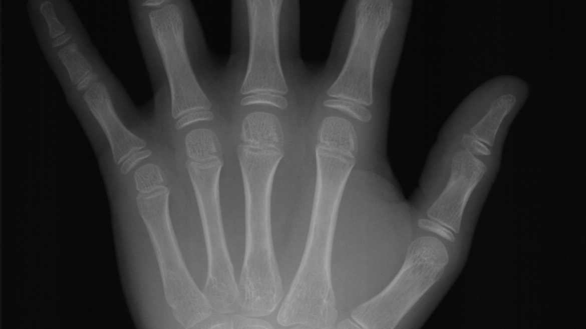 Radiografia de Mão e Punho para análise de Idade Óssea