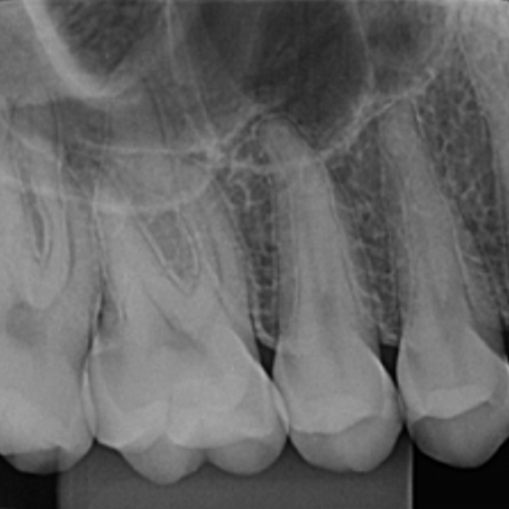 Radiografia Periapical