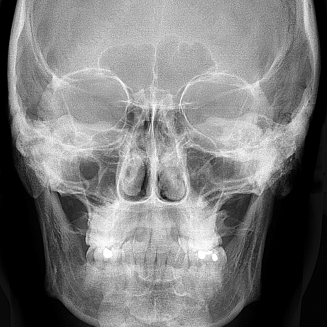 Telerradiografia em Norma Lateral e Frontal